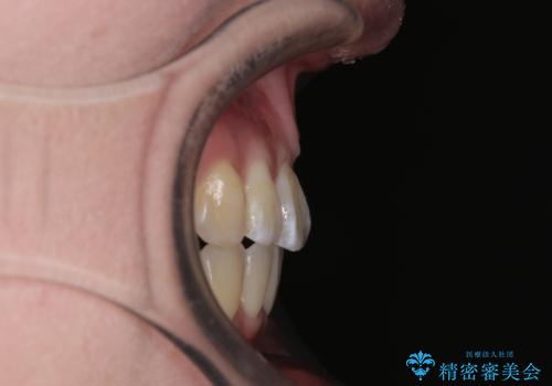 【モニター】口が閉じられない ワイヤー装置での抜歯矯正の治療後