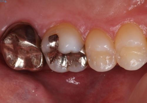 セラミックインレーとクラウンで歯ぐきの腫れを治すの治療前