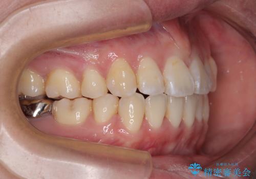 【モニター】口が閉じられない ワイヤー装置での抜歯矯正の治療後