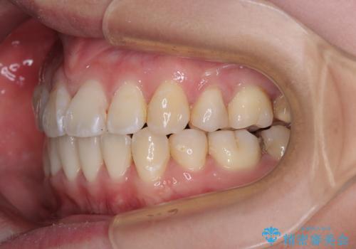 【モニター】口が閉じられない ワイヤー装置での抜歯矯正の治療後