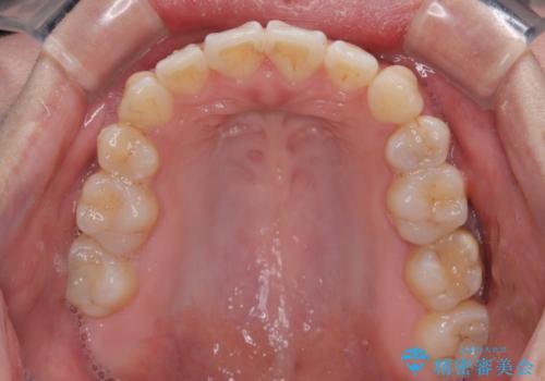 【モニター】口が閉じられない ワイヤー装置での抜歯矯正の治療後