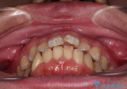 口が閉じられない 抜歯矯正で前歯の突出感を改善の治療前