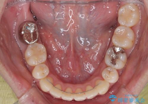 【モニター】口が閉じられない ワイヤー装置での抜歯矯正の治療後