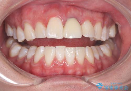 オフィスホワイトニング