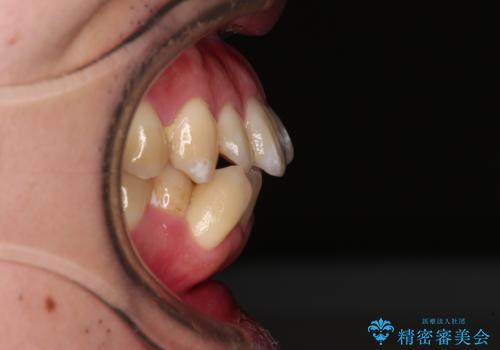 口が閉じられない 抜歯矯正で前歯の突出感を改善の治療前
