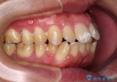 口が閉じられない 抜歯矯正で前歯の突出感を改善の治療前