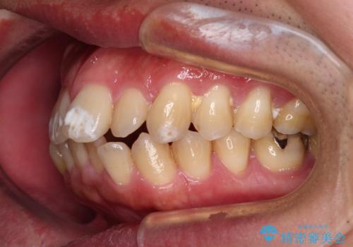 口が閉じられない 抜歯矯正で前歯の突出感を改善の治療前