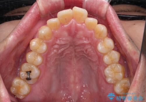 口が閉じられない 抜歯矯正で前歯の突出感を改善の治療前