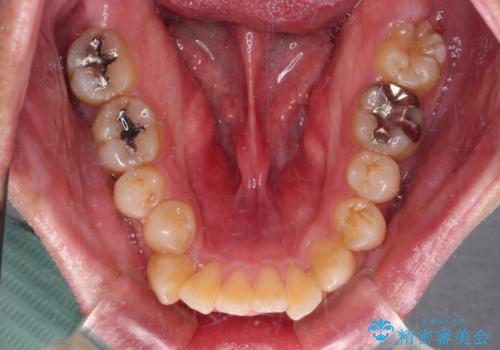 口が閉じられない 抜歯矯正で前歯の突出感を改善の治療前