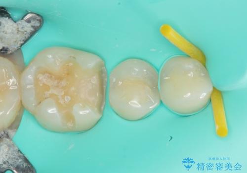 金属の詰め物が目立つのでやり替えたい ハイブリッドインレー修復の治療中