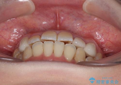 むし歯と八重歯を治したい 総合歯科治療の治療後
