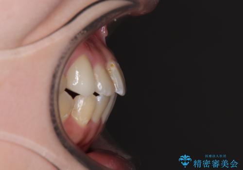 むし歯と八重歯を治したい 総合歯科治療の治療後