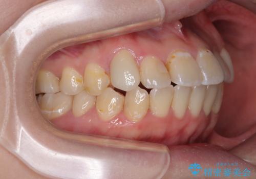 むし歯と八重歯を治したい 総合歯科治療の治療後