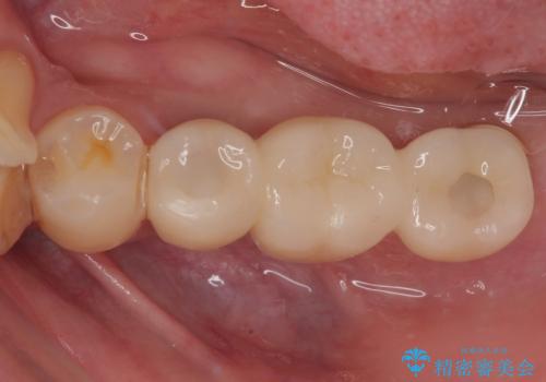 放置していたむし歯 抜歯即時埋入インプラントによる補綴治療の治療後