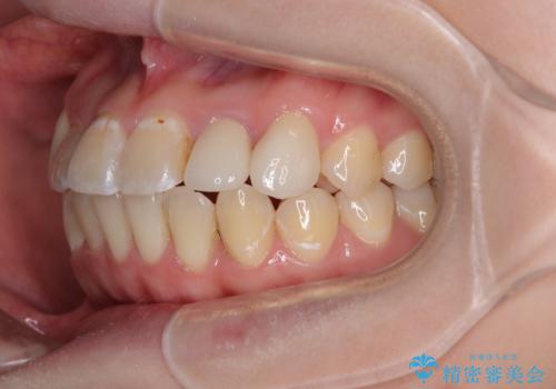 むし歯と八重歯を治したい 総合歯科治療の治療後