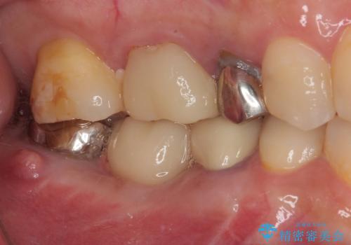 放置していたむし歯 抜歯即時埋入インプラントによる補綴治療の治療後