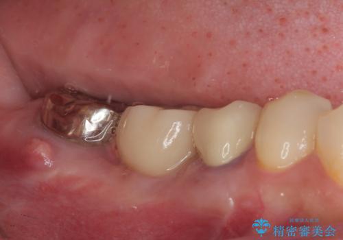 放置していたむし歯 抜歯即時埋入インプラントによる補綴治療の治療後