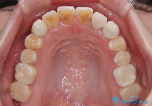 むし歯と八重歯を治したい 総合歯科治療の治療後