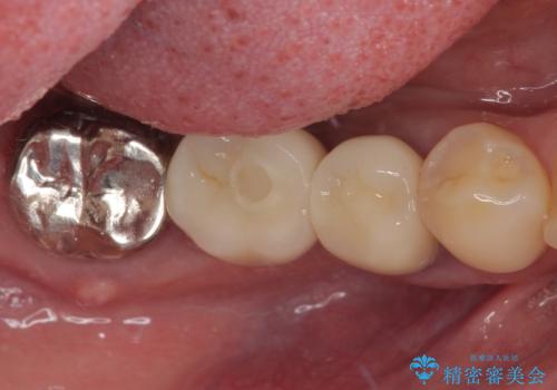 放置していたむし歯 抜歯即時埋入インプラントによる補綴治療の治療後