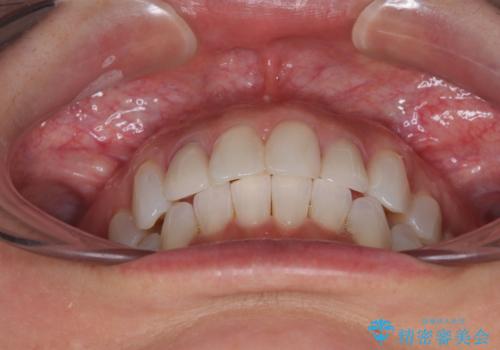 前歯のデコボコとむし歯治療の跡 インビザライン矯正とオールセラミッククラウン治療の治療後
