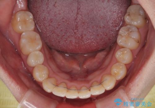 むし歯と八重歯を治したい 総合歯科治療の治療後