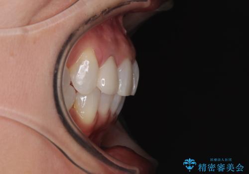 前歯のデコボコとむし歯治療の跡 インビザライン矯正とオールセラミッククラウン治療の治療後
