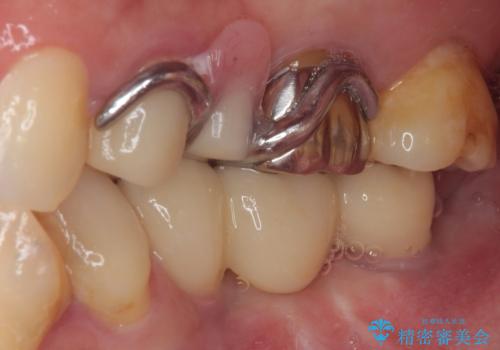 放置していたむし歯 抜歯即時埋入インプラントによる補綴治療の治療後