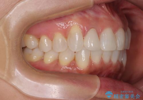 前歯のデコボコとむし歯治療の跡 インビザライン矯正とオールセラミッククラウン治療の治療後