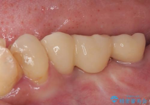 放置していたむし歯 抜歯即時埋入インプラントによる補綴治療の治療後
