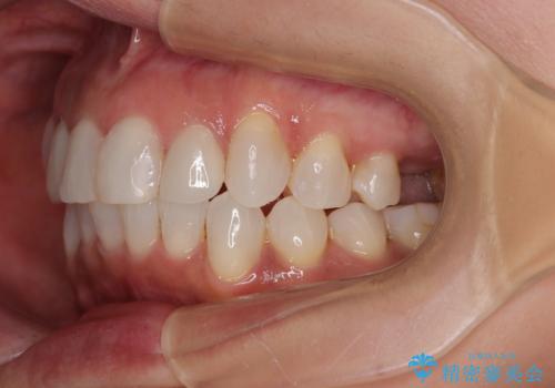 前歯のデコボコとむし歯治療の跡 インビザライン矯正とオールセラミッククラウン治療の治療後