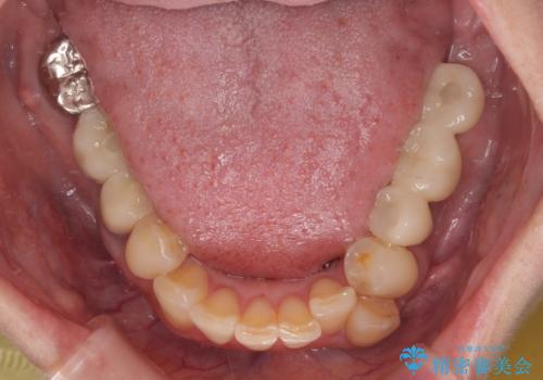 放置していたむし歯 抜歯即時埋入インプラントによる補綴治療の症例 治療後