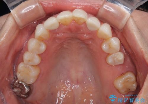 前歯のデコボコとむし歯治療の跡 インビザライン矯正とオールセラミッククラウン治療の治療後