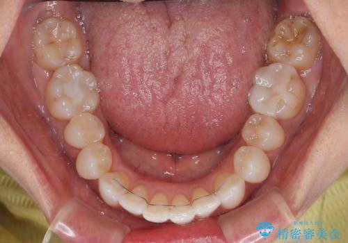 前歯のデコボコとむし歯治療の跡 インビザライン矯正とオールセラミッククラウン治療の治療後