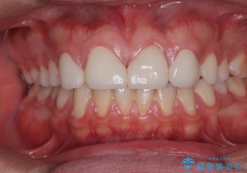 欠損して隙間のある前歯 オールセラミッククラウンで自然な口元にの治療後