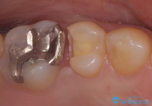 セラミックインレー 虫歯の治療の治療中