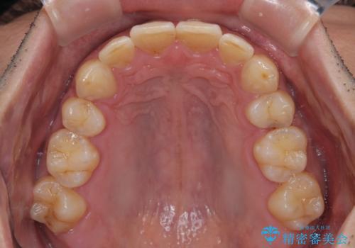 飛び出した前歯を治したい　ワイヤー装置での抜歯矯正の治療後