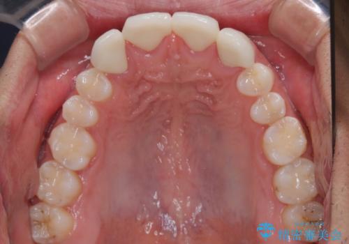 欠損して隙間のある前歯 オールセラミッククラウンで自然な口元にの治療後