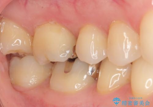 金属の詰め物が目立つのでやり替えたい ハイブリッドインレー修復の治療前