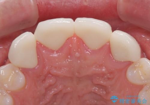 欠損して隙間のある前歯 オールセラミッククラウンで自然な口元にの治療後