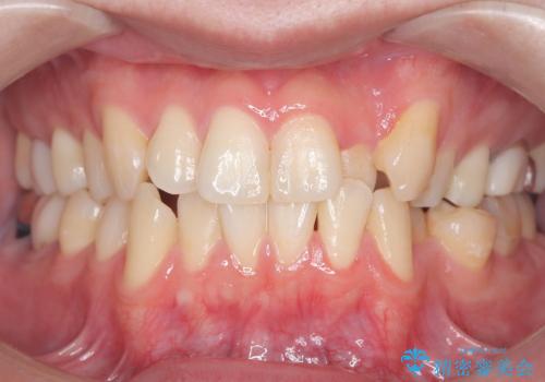 初めてのオフィスホワイトニング