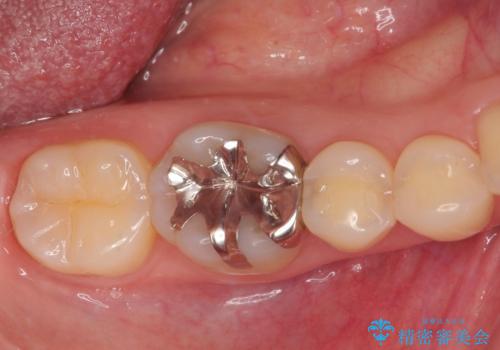 金属の詰め物が目立つのでやり替えたい ハイブリッドインレー修復の症例 治療前