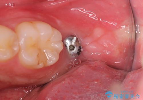 痛くないインプラント治療|1回の手術で終了!|エンドペリオ病変|オールセラミッククラウンの治療中