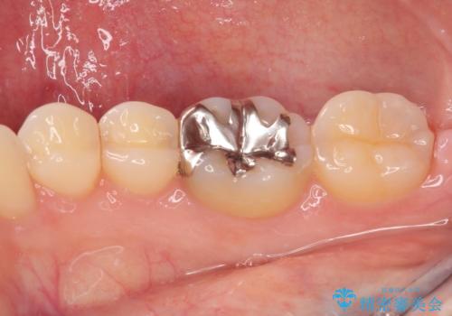 金属の詰め物が目立つのでやり替えたい ハイブリッドインレー修復の治療前
