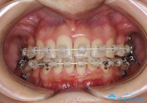 ワイヤー矯正治療中に歯の着色を綺麗にの症例 治療後