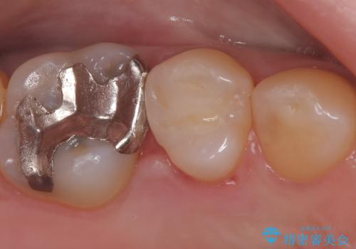 セラミックインレー 虫歯の治療の治療後