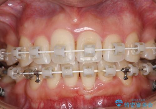 ワイヤー矯正治療中に歯の着色を綺麗にの治療後