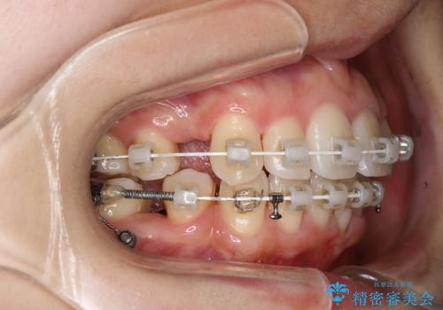 ワイヤー矯正治療中に歯の着色を綺麗にの治療後