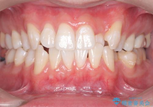 初めてのオフィスホワイトニングの治療後