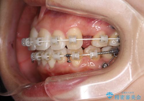 ワイヤー矯正治療中に歯の着色を綺麗にの治療後