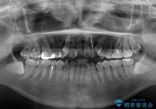 むし歯と八重歯を治したい 総合歯科治療の治療前